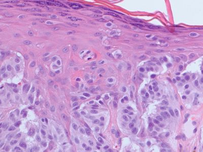 W Skin Biopsies Read by Board Certified Dermatopathologist