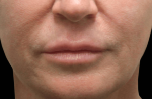 woman's lower face and jowls before ellacor micro-coring treatment