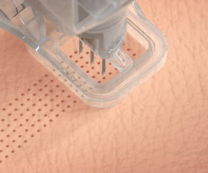 A close-up illustration of the Ellacor micro-coring needles in action, showing the needles precisely removing small sections of skin. The needles are depicted as tiny cylindrical tools penetrating the skin surface, with removed skin cores being extracted. The background is neutral, emphasizing the detailed operation of the needles and the texture of the skin.