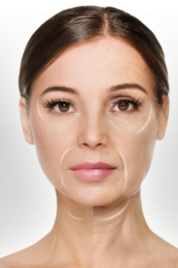 Before and after shot of a woman who has had the CO2 RE laser resurfacing on her face.